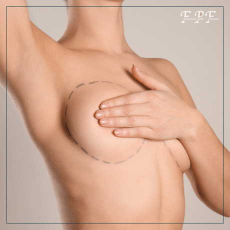 Seno cadente risolvere con la mastopessi Dr. Fonzone