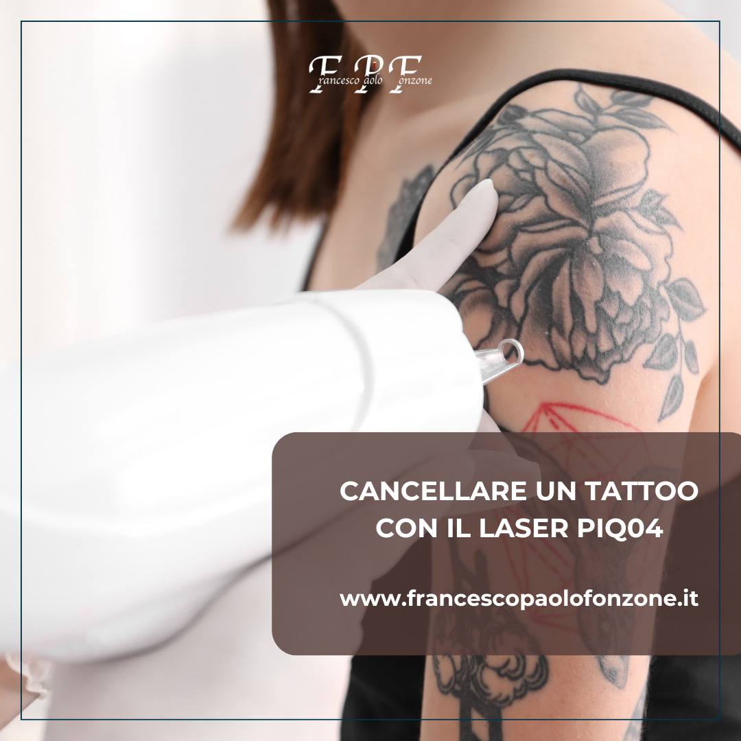tattoo - Chirurgo Plastico Napoli